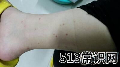 梦见虫子咬我